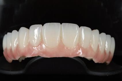 Milled full-arch restoration