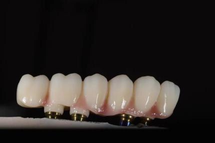 Milled implant-supported restoration